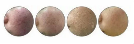 NEWNEW|修復(fù)痘坑痘印還得靠海藻煥膚