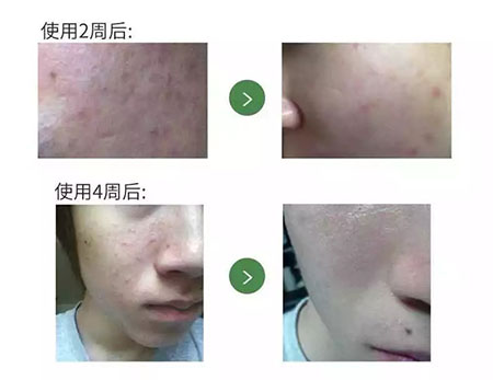 New&New|比春敏更痛苦的事...不要讓爆痘毀了你的臉！