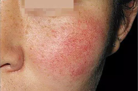 拒絕春季過(guò)敏、紅腫、發(fā)癢！敏感肌的救星來(lái)啦~